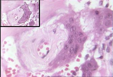 Osteoclastos en hueso