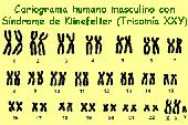 Hombre con trisom�a XXY (Klinefelter)